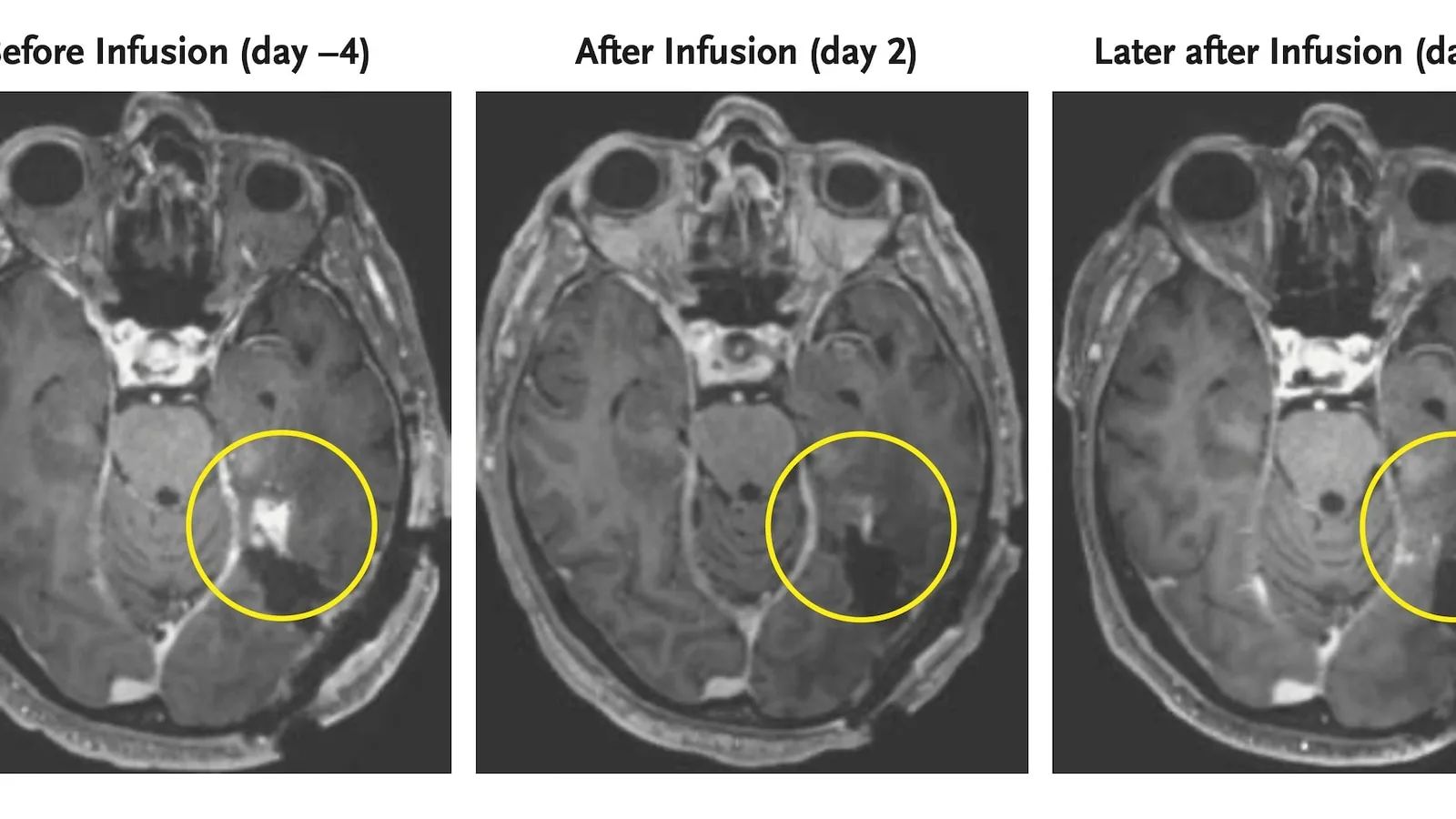 A new strategy to attack aggressive brain cancer shrank tumors in two early tests – usreport.online