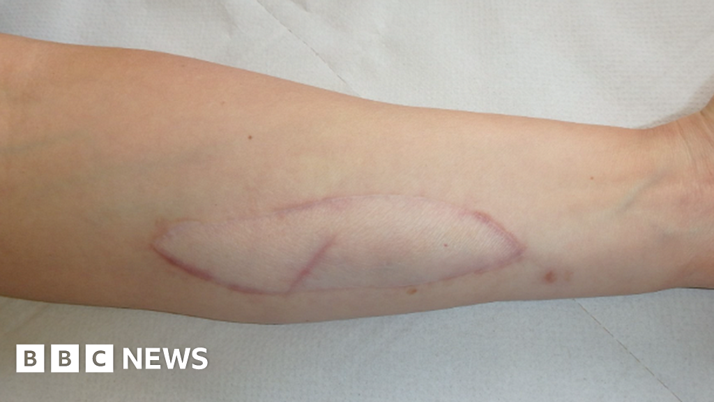 Arm skin patch system could warn of organ rejection – usreport.online